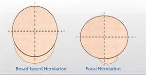 Broad based disc bulge