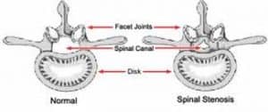 spinal stenosis