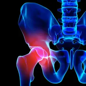 3D illustration, hip painful skeleton x-ray, medical concept.