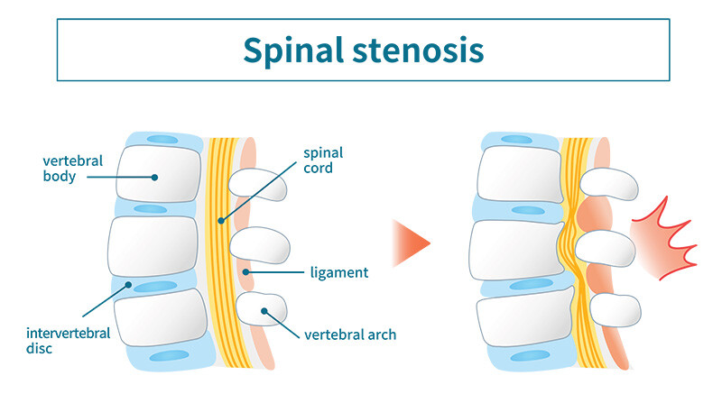 Labeled diagram of spinal stenosis anatomy.